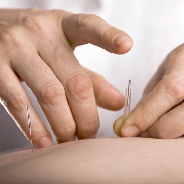 Click Here To Enlarge This Photo Of DRY NEEDLING/ ACUPUNCTURE