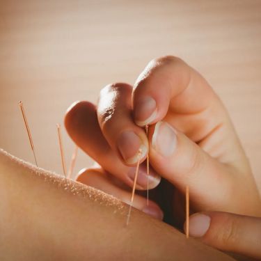 Click Here To Enlarge This Photo Of DRY NEEDLING/ ACUPUNCTURE