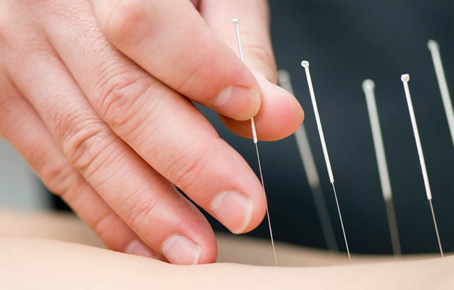 Acupuncture / Dry Needling
