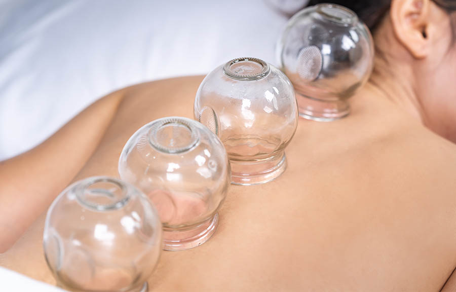 Medical Cupping Therapy